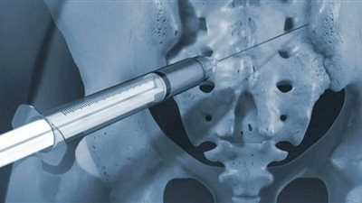 ثورة في الطب التجديدي.. تقنية جديدة لاستعادة العظام المفقودة