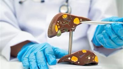 اعرف طرق علاج انسداد القناة الصفراوية