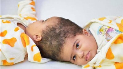 السعودية .. نجاح فصل التوأم الملتصق الإريتري «أسماء وسمية» بعد عملية جراحية دقيقة