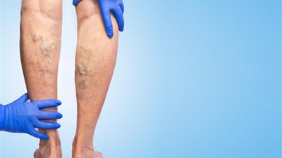 أسباب شائعة للإصابة بـ دوالي الساقين.. احذرها